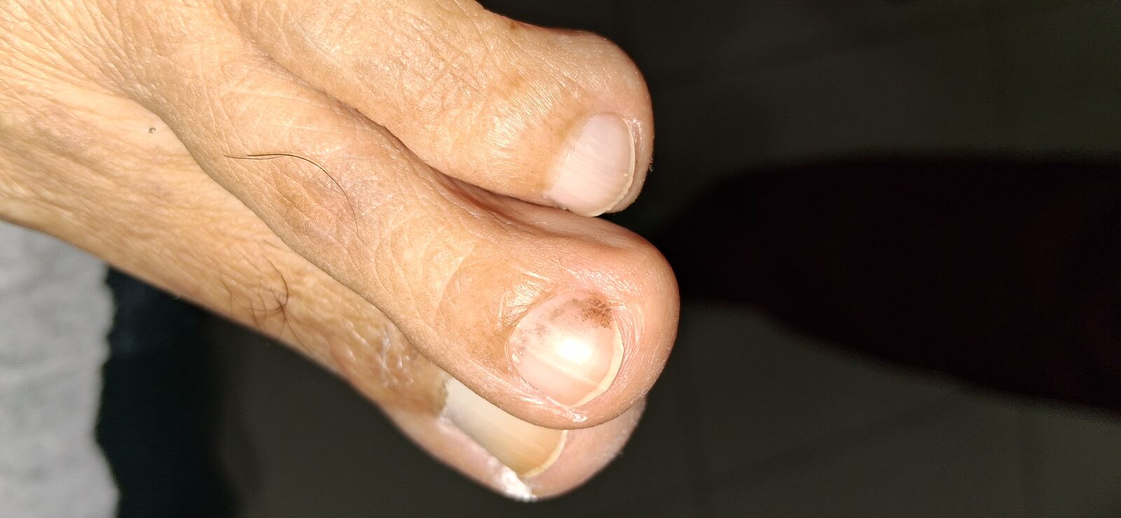 Clinical case: Tinea nigra