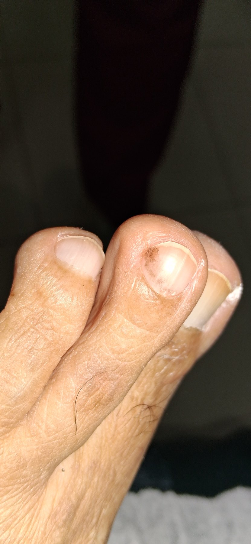 Tinea nigra: before image