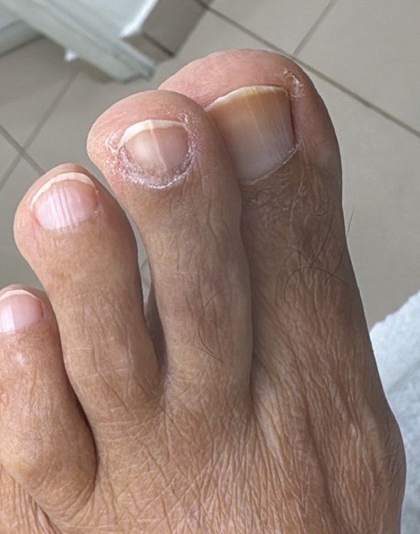 Tinea nigra: after image