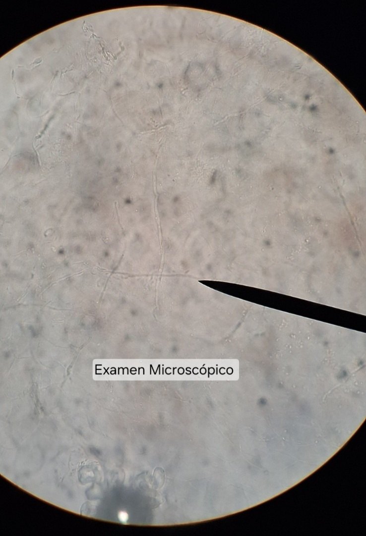 Clinical case of Tinea nigra