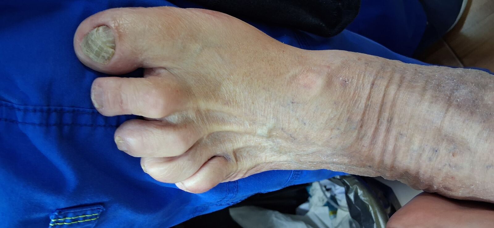 Tinea pedis: before image