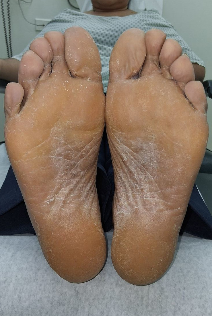 Tinea pedis: after image