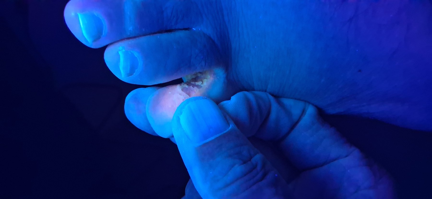 Clinical case of Tinea pedis and erythrasma