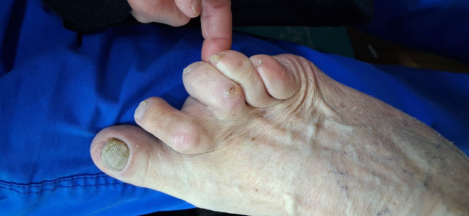 Clinical case: Tinea pedis