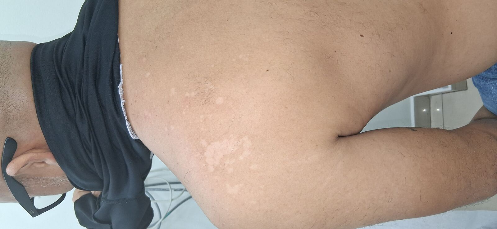 Tinea versicolor: before image