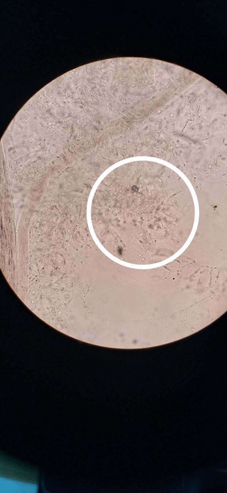 Tinea versicolor: after image