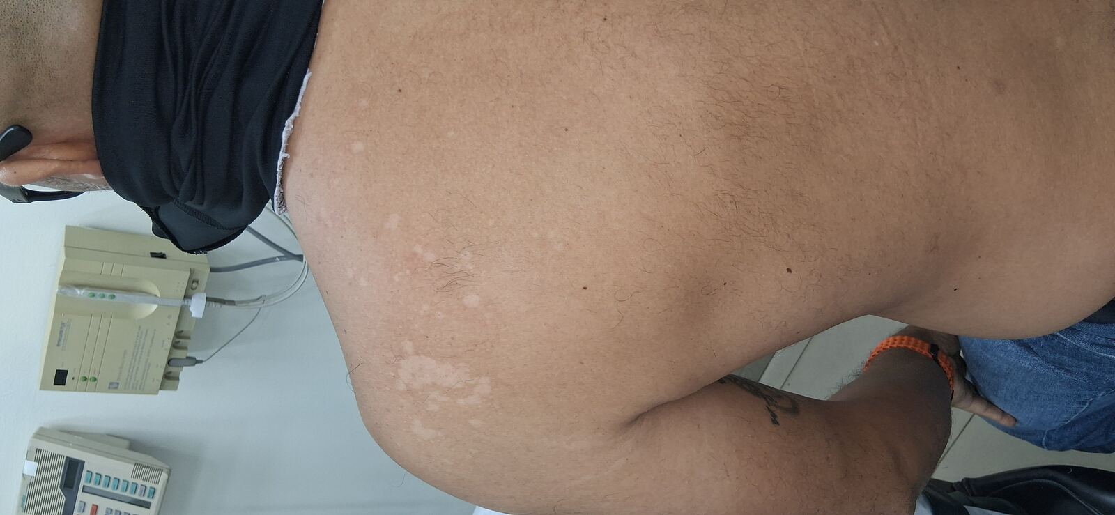 Clinical case: Tinea versicolor