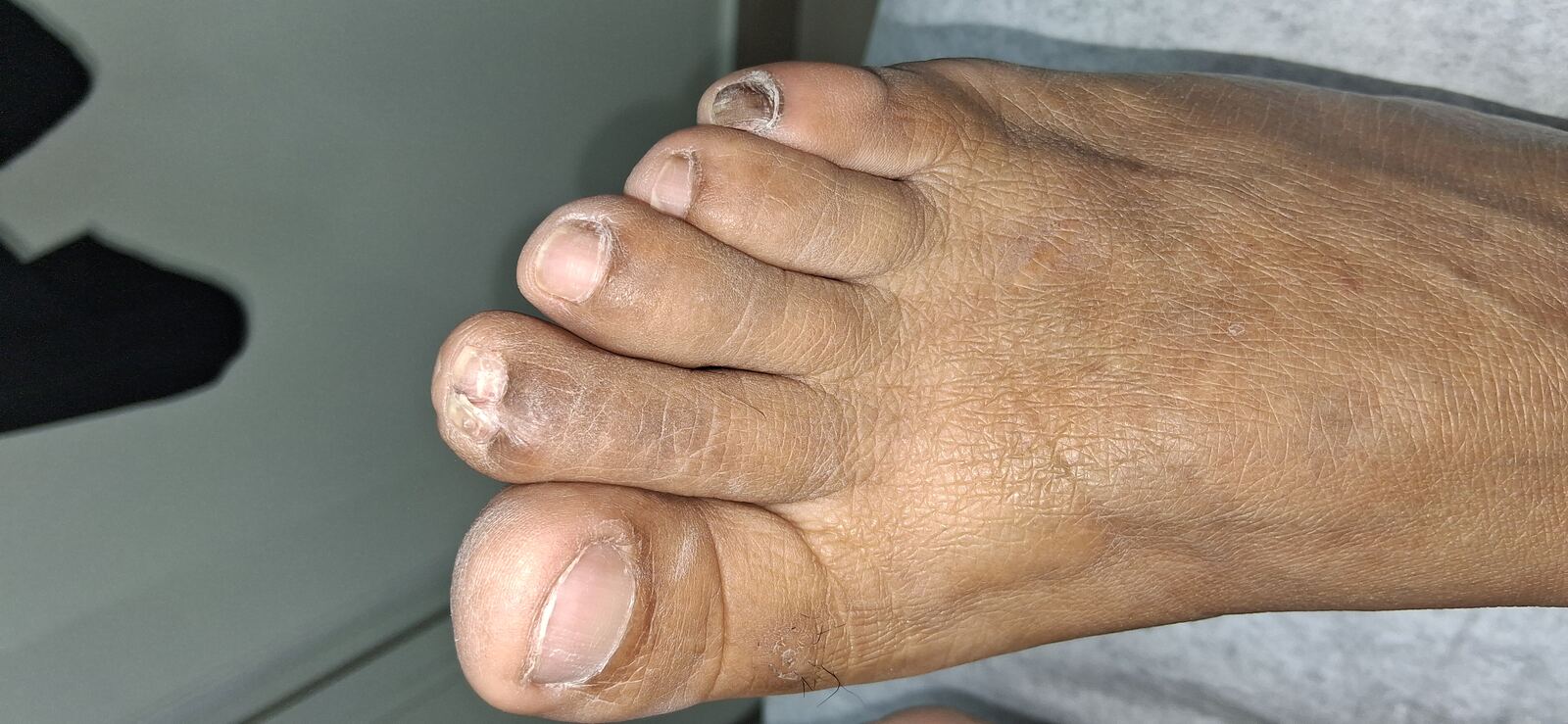 Glomus tumor: before image