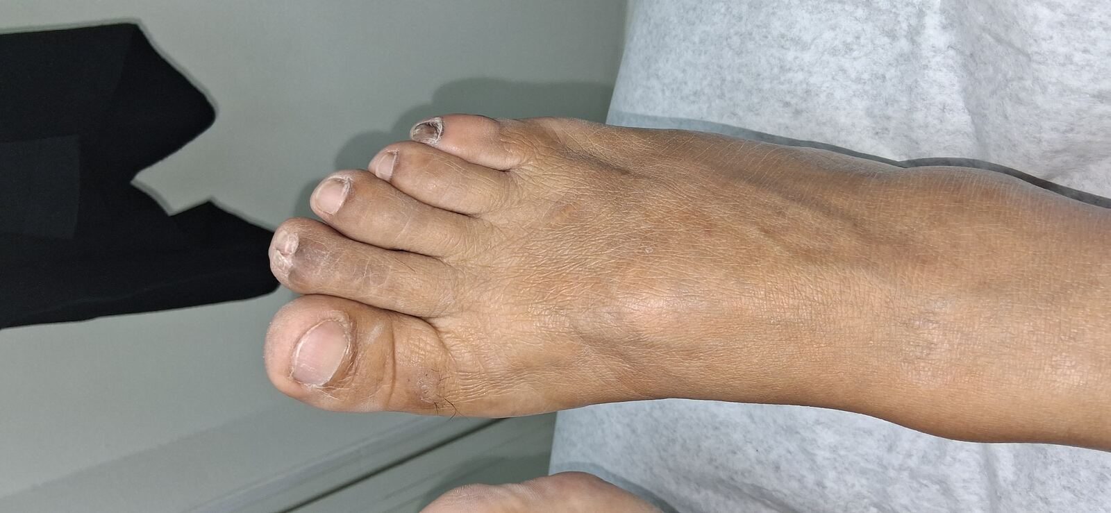 Clinical case: Glomus tumor