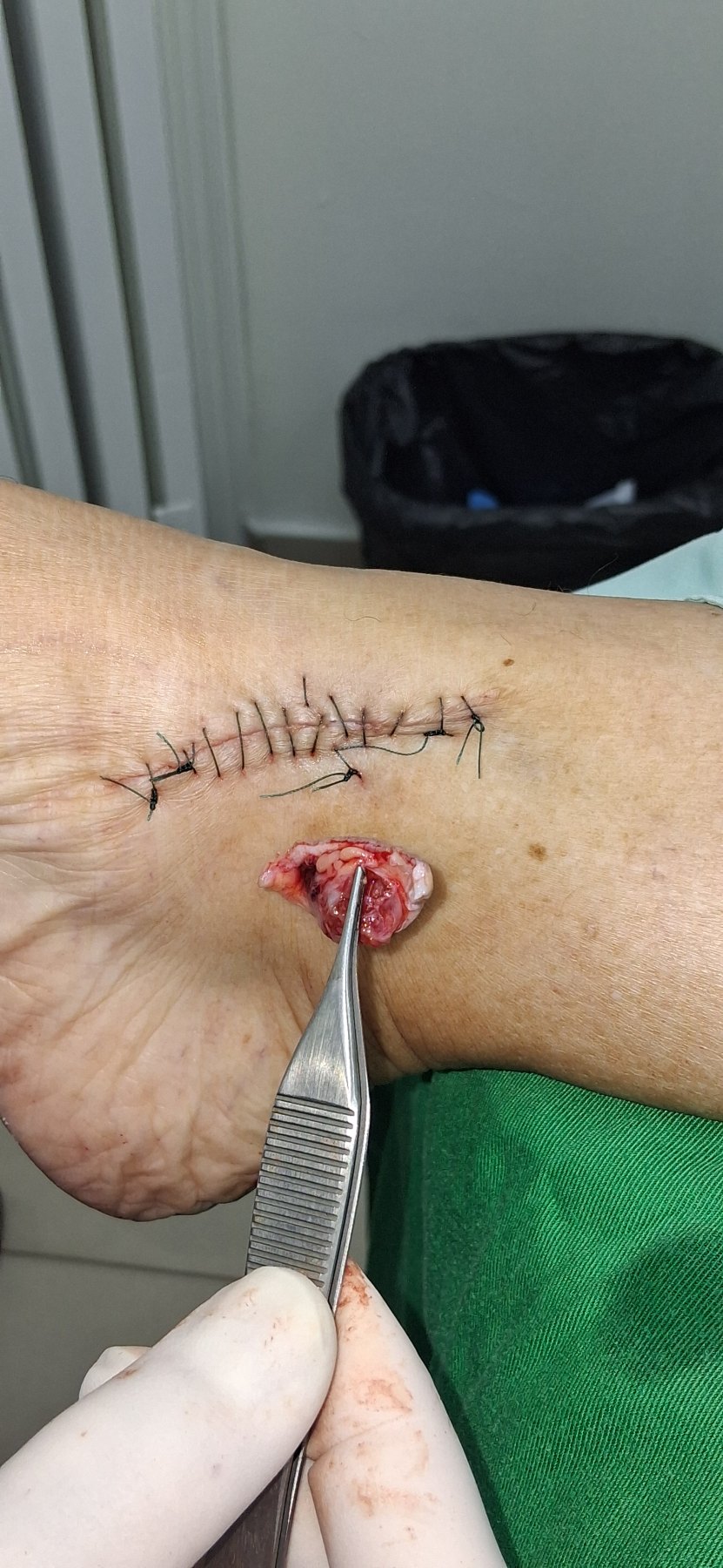Mixed tumor: before image
