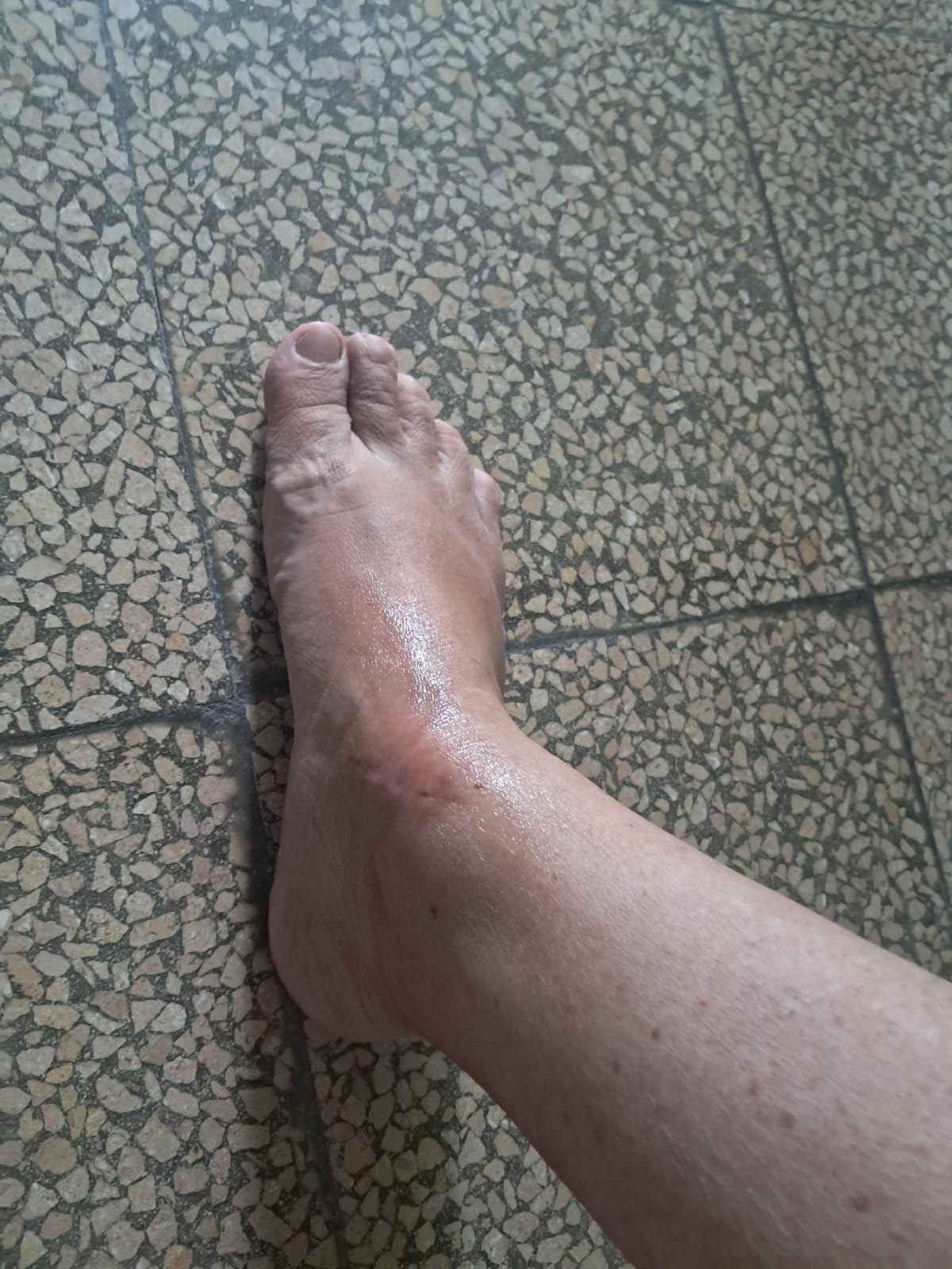 Mixed tumor: after image