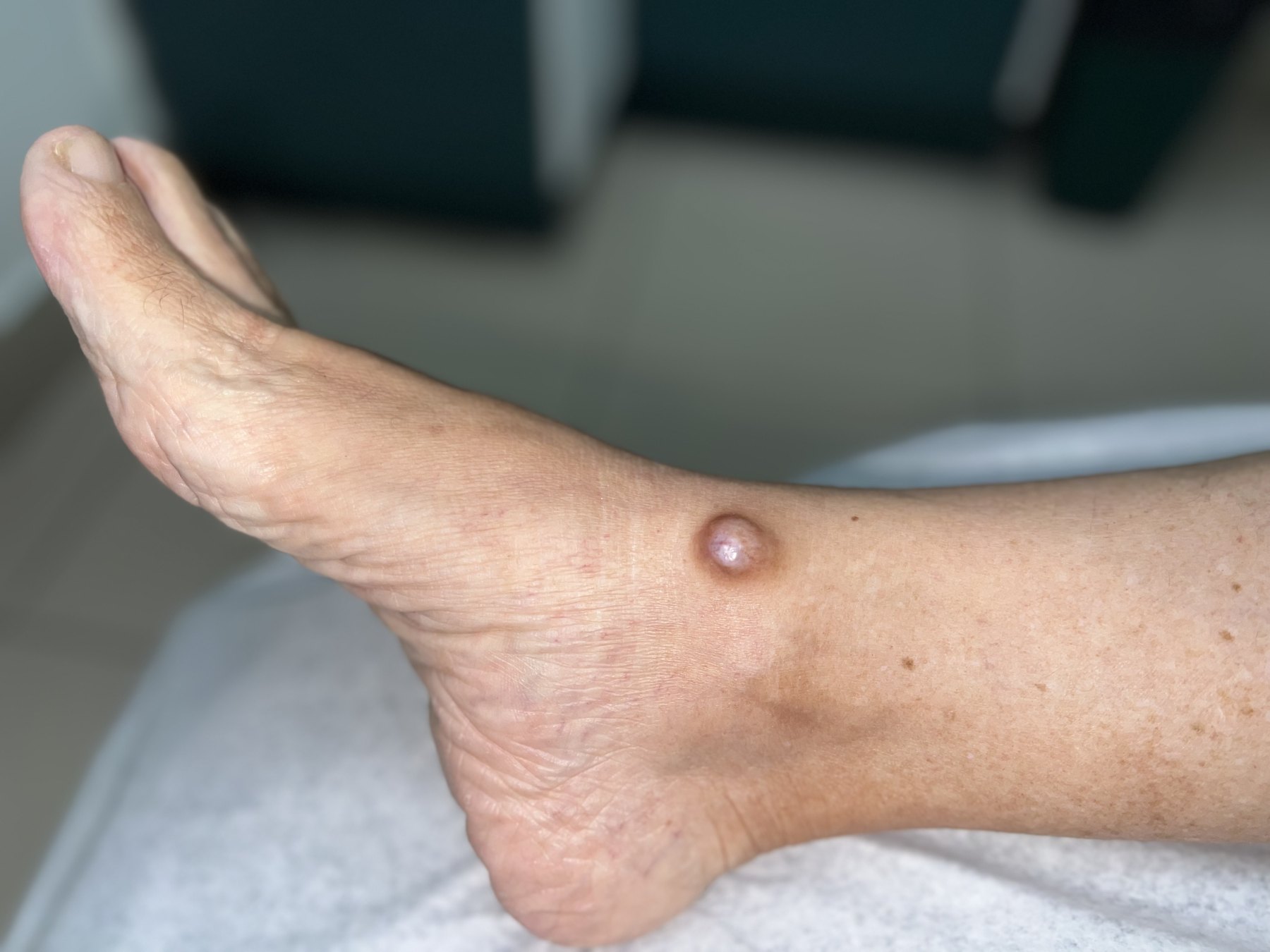 Clinical case of Mixed tumor