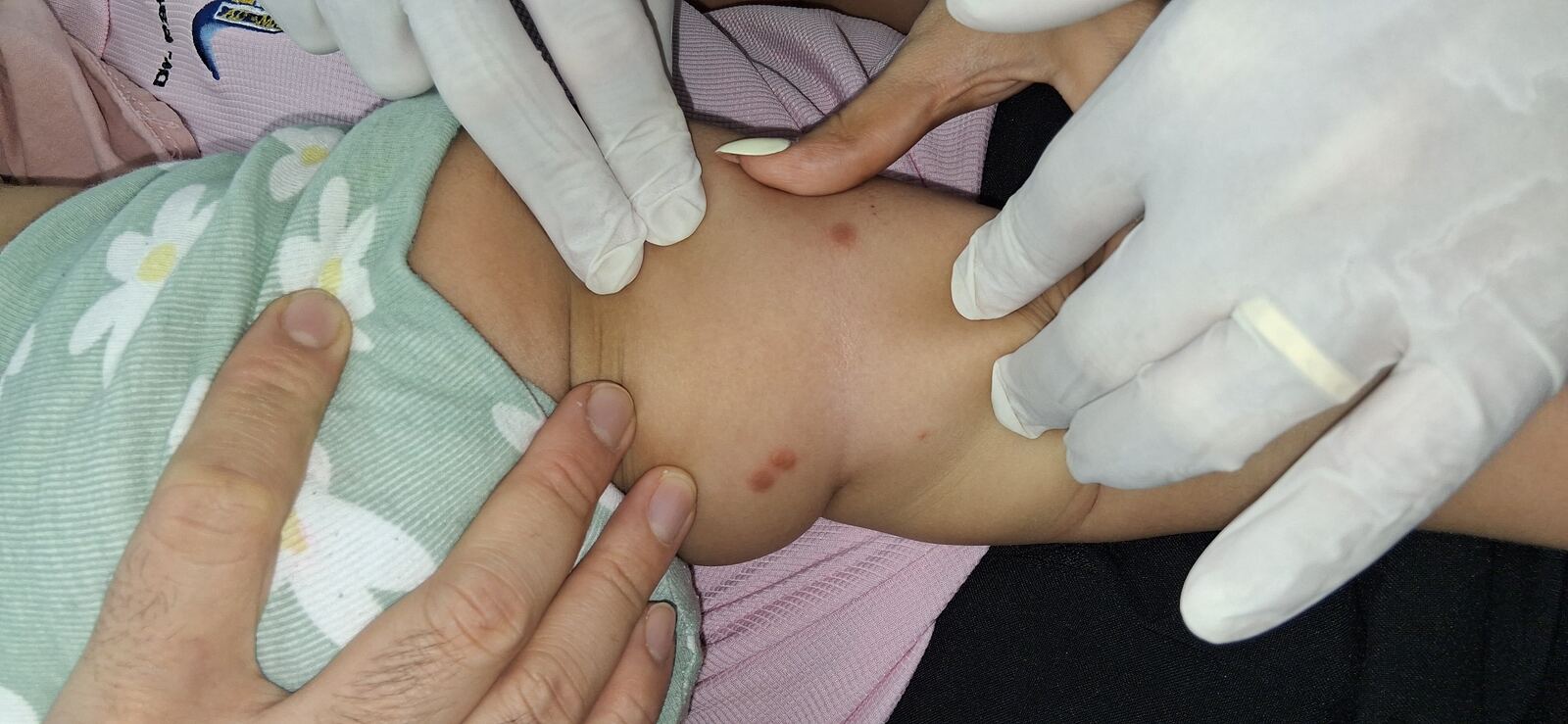 Papular urticaria, mastocytosis and cutaneous lymphocytosis: before image