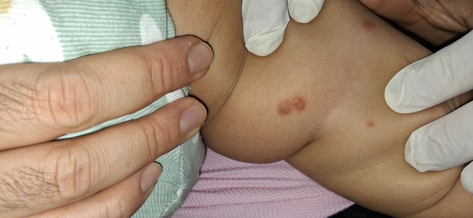 Papular urticaria, mastocytosis and cutaneous lymphocytosis: after image