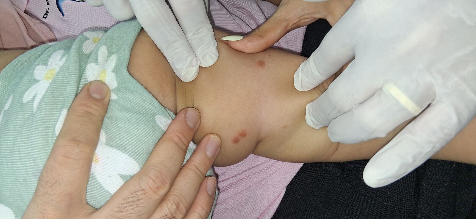 Clinical case: Papular urticaria, mastocytosis and cutaneous lymphocytosis