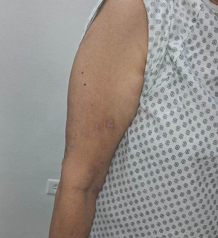 Varicella zoster: before image