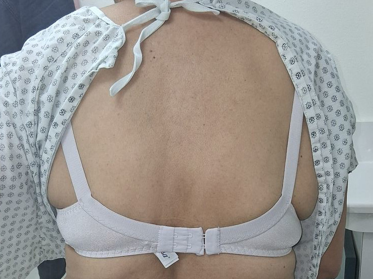 Varicella zoster: after image