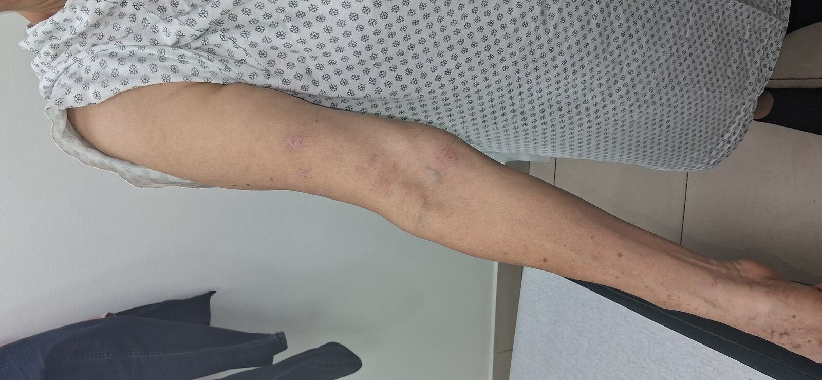 Clinical case: Varicella zoster