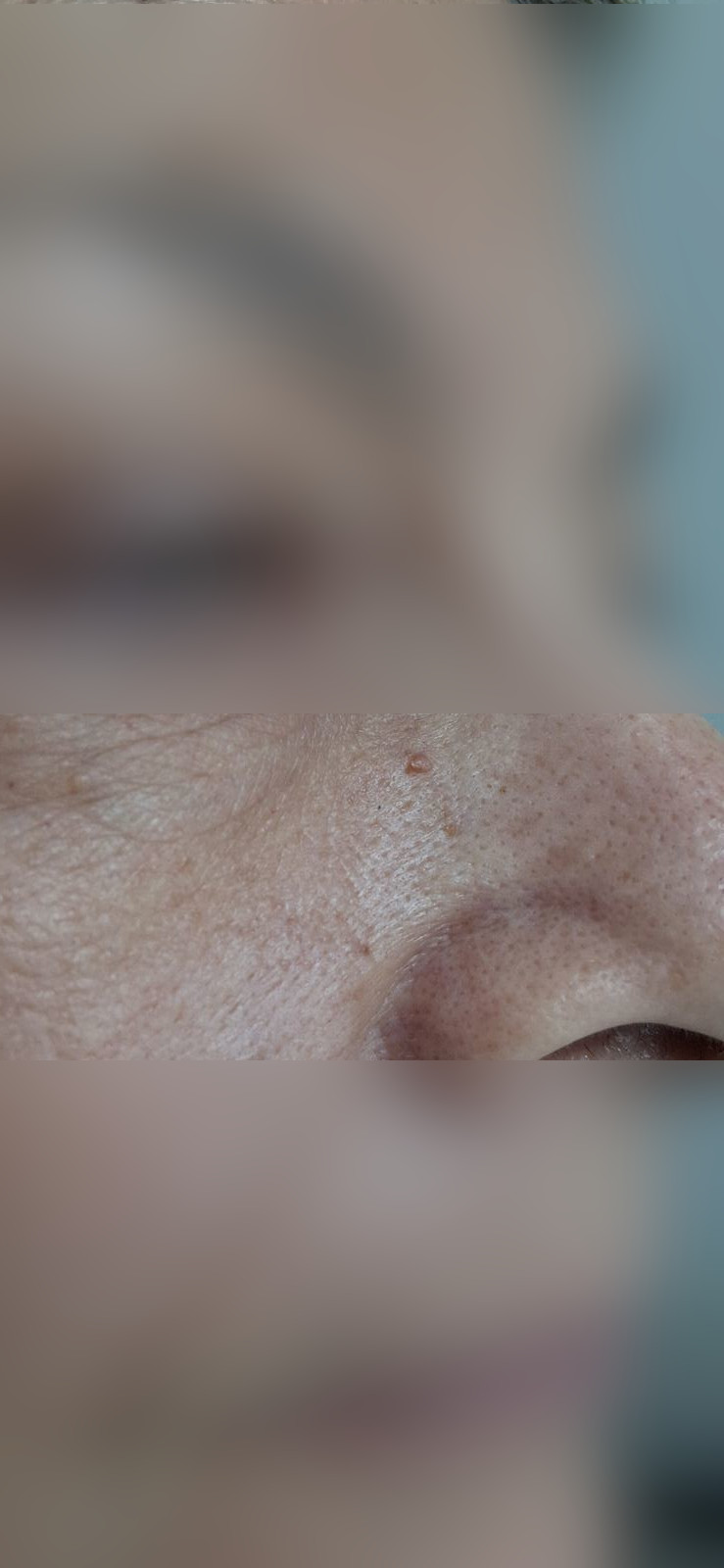 Filiform wart: after image