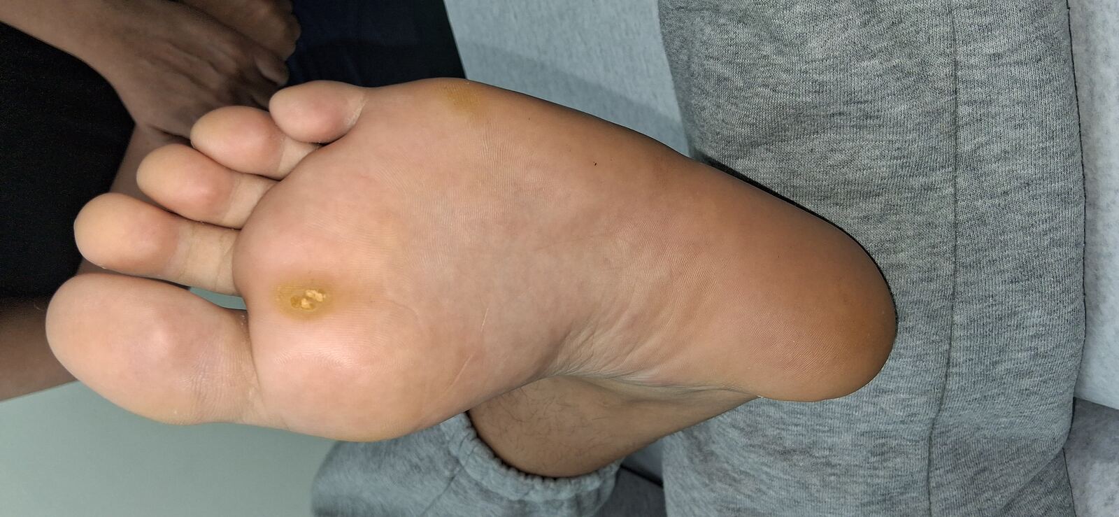Clinical case: Plantar wart