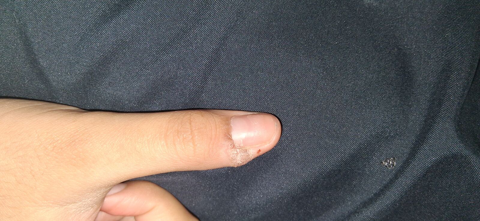 Common wart: before image
