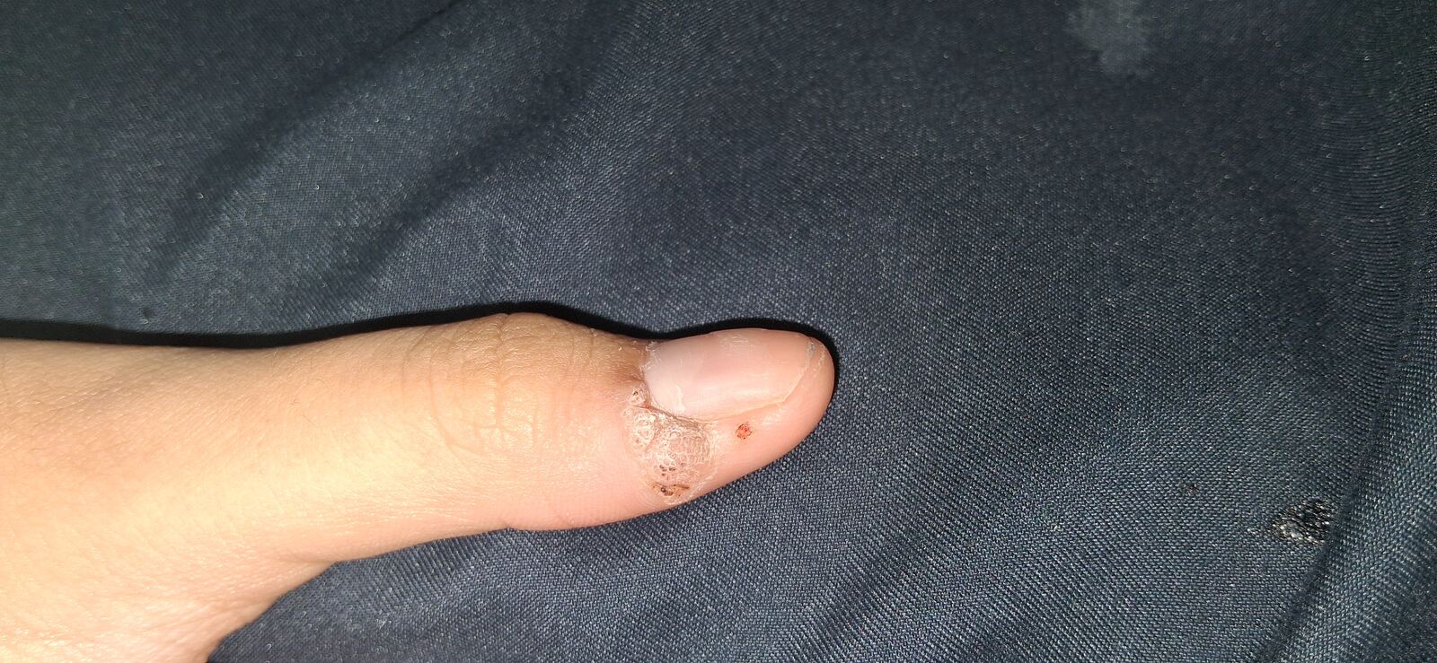 Common wart: after image