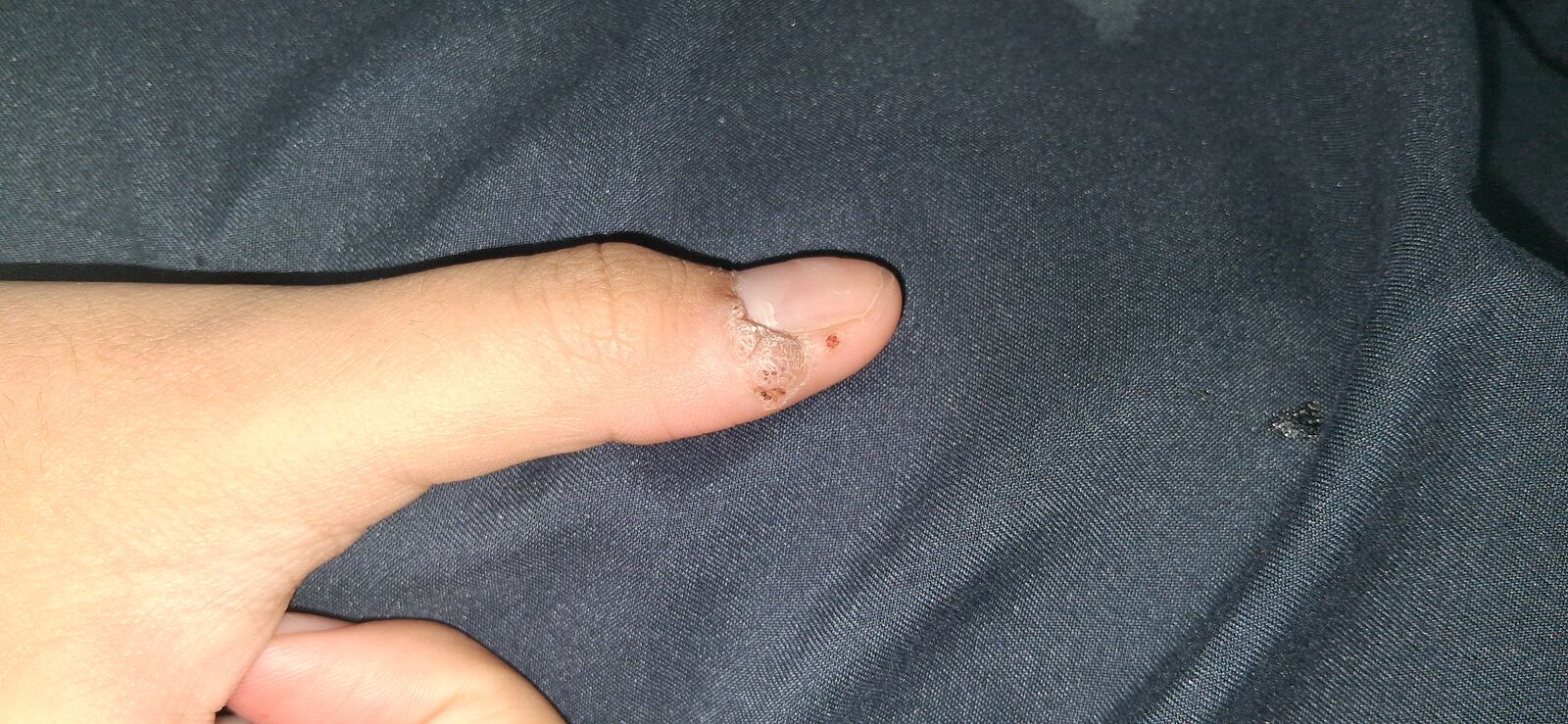 Clinical case: Common wart