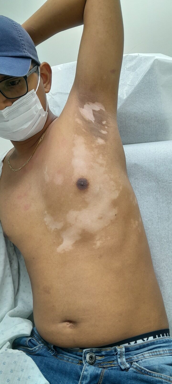 Vitiligo: before image