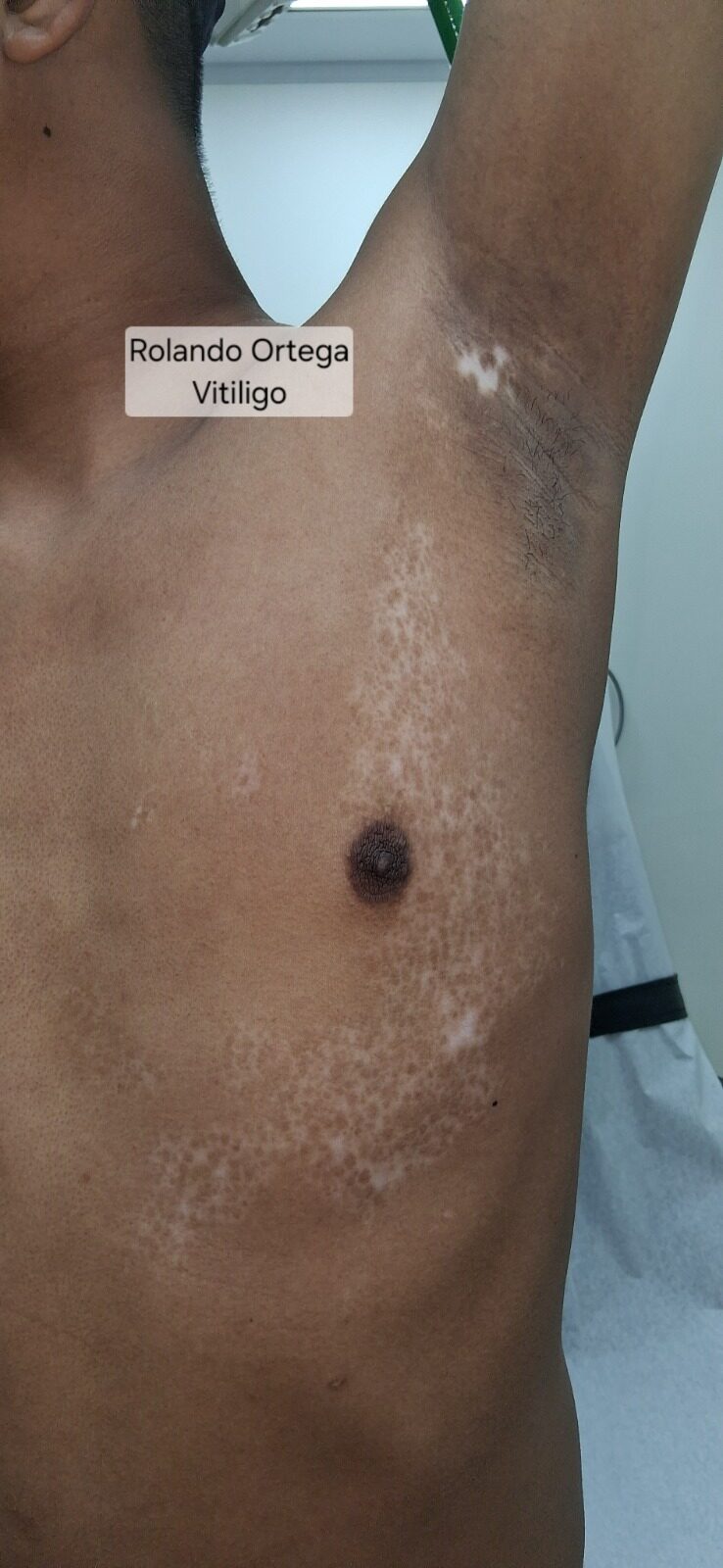 Vitiligo: after image