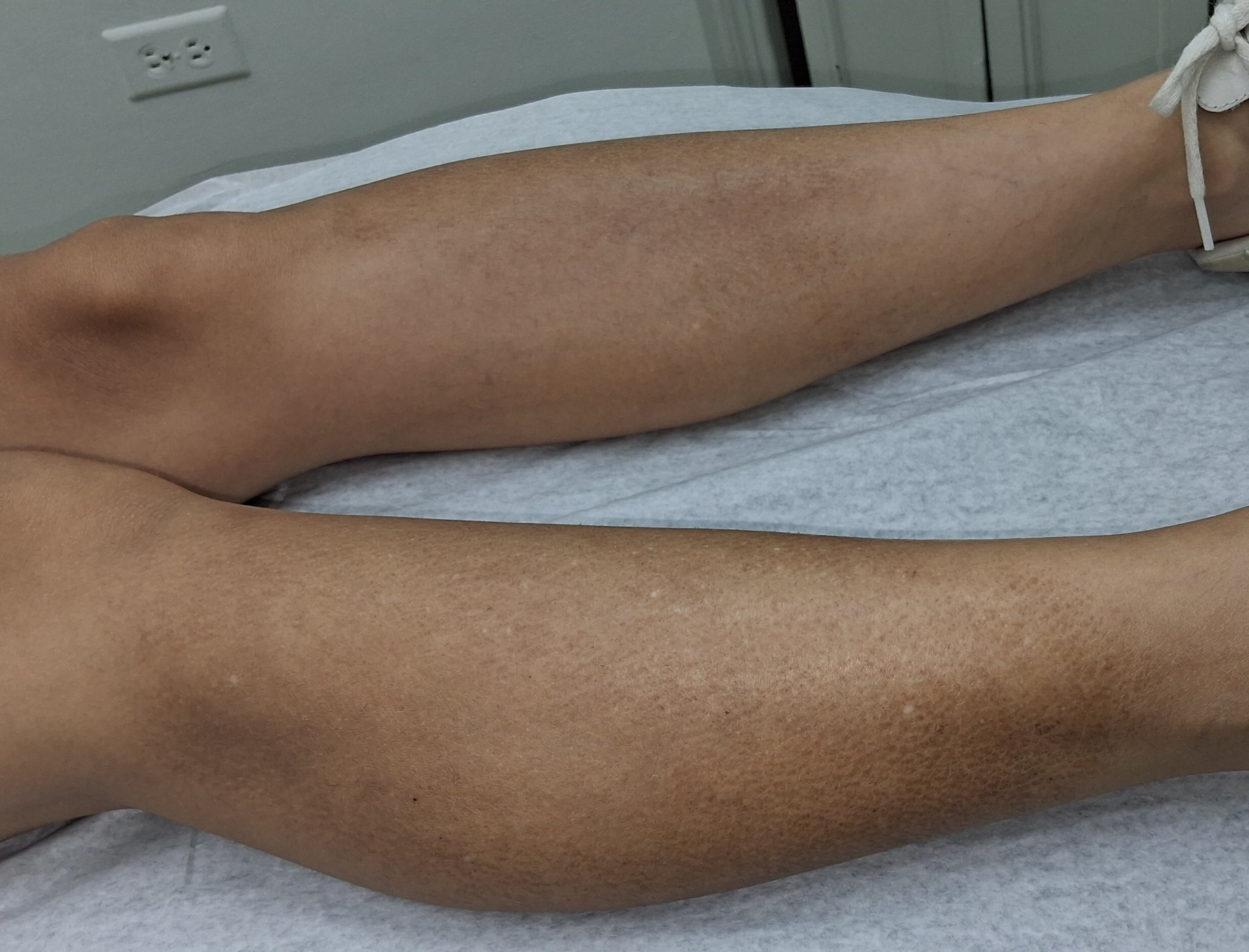 Xerosis: before image