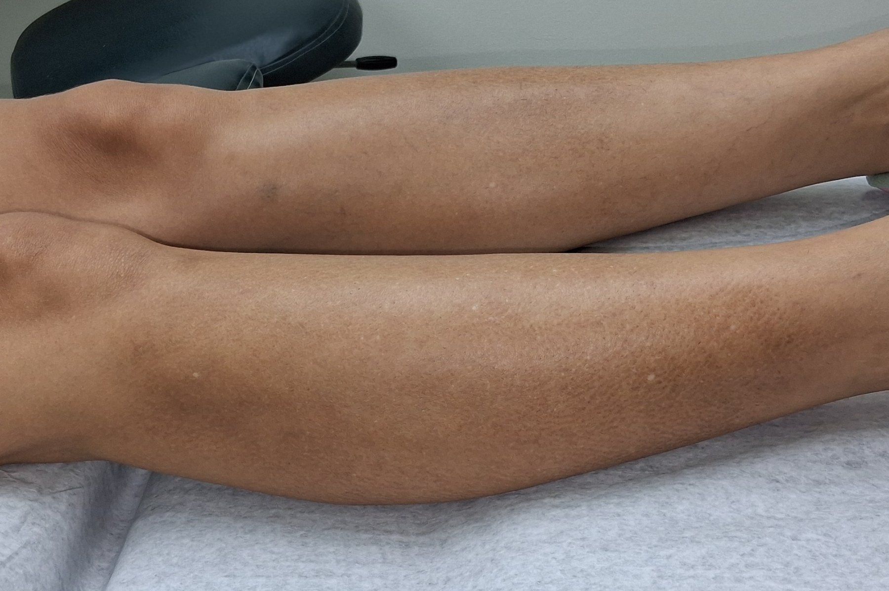 Xerosis: after image