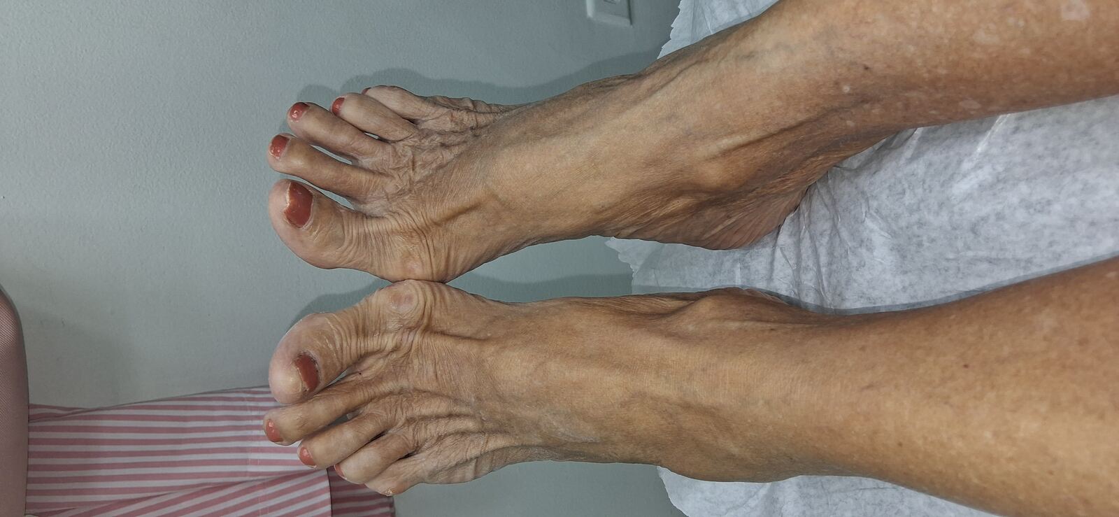 Clinical case: Xerosis