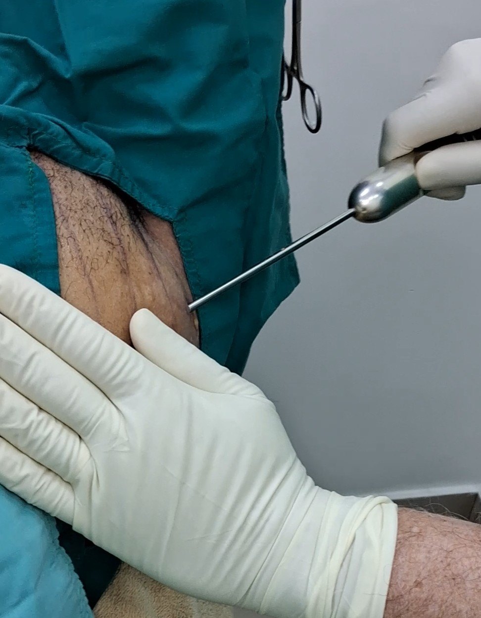 Before: Lipoma