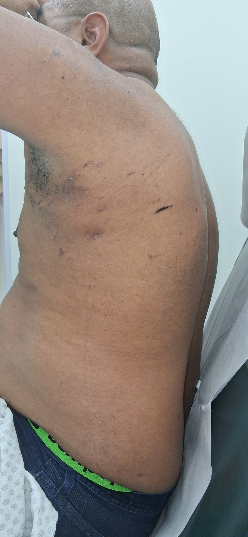 After: Lipoma