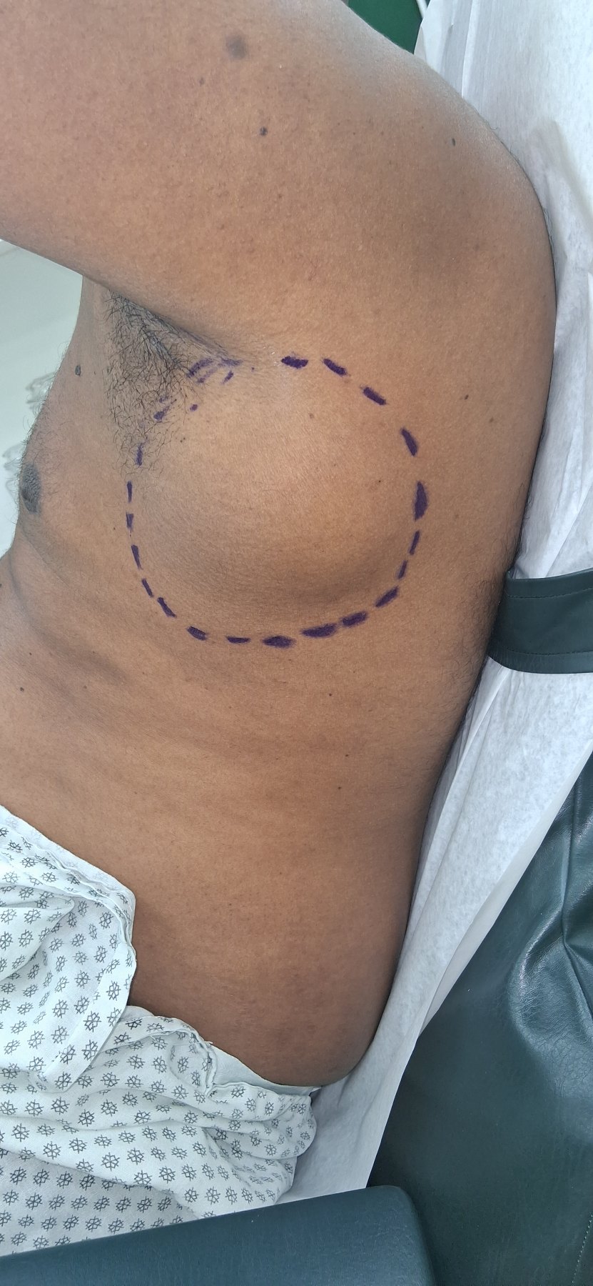Lipoma