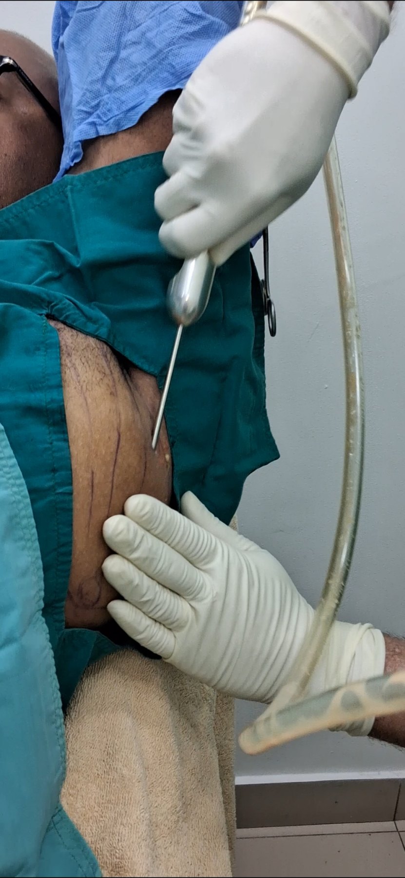 Before: Lipoma