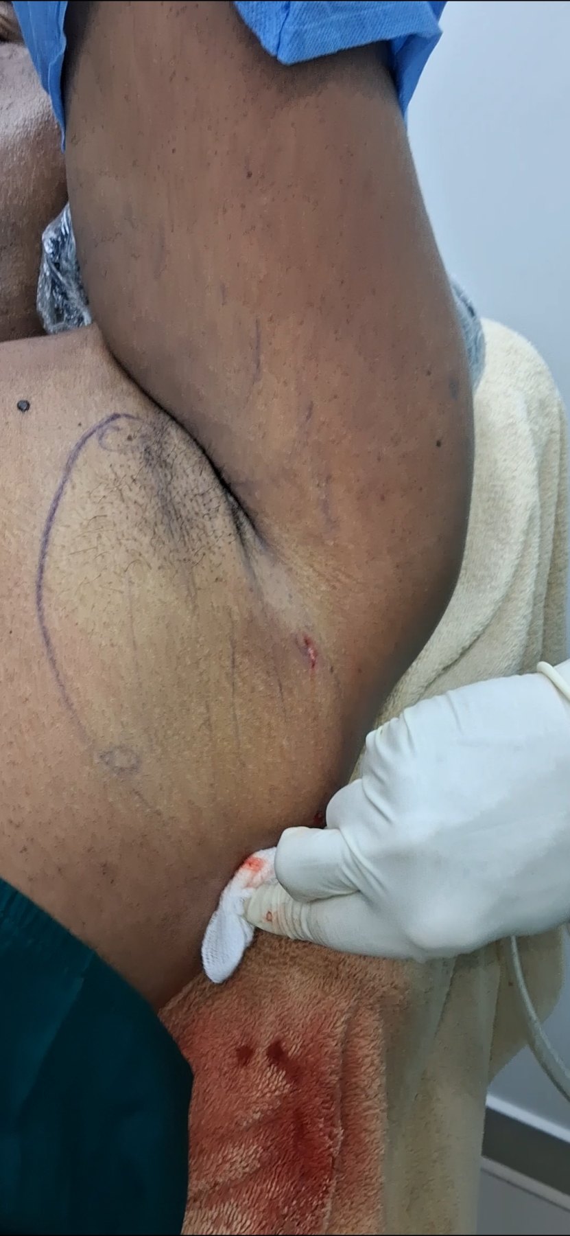 After: Lipoma