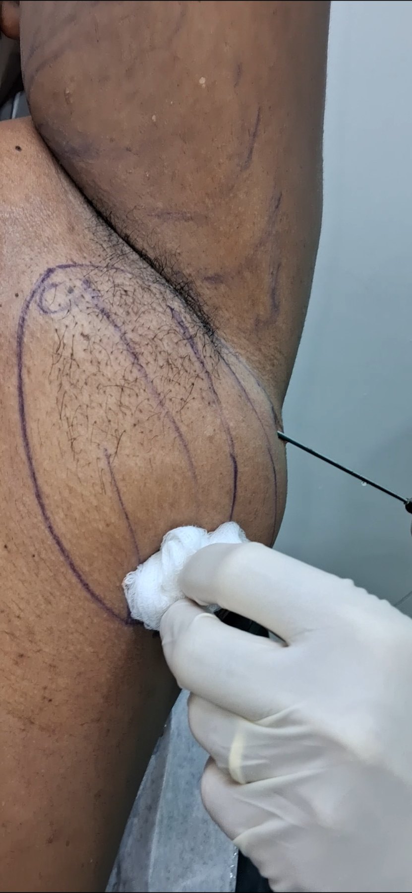 Lipoma
