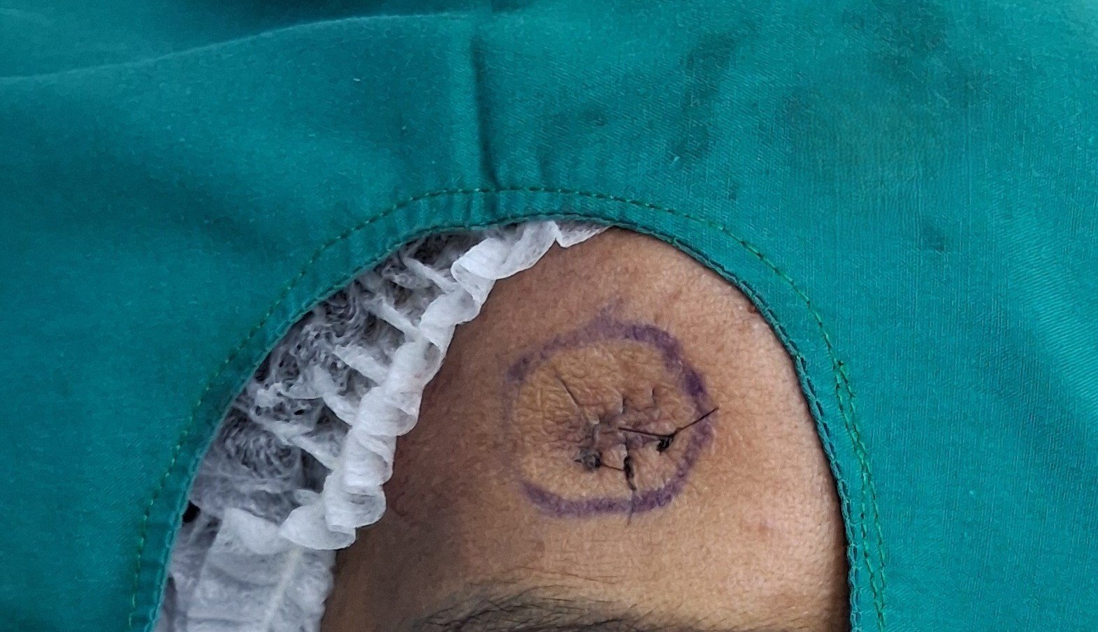 Before: Lipoma