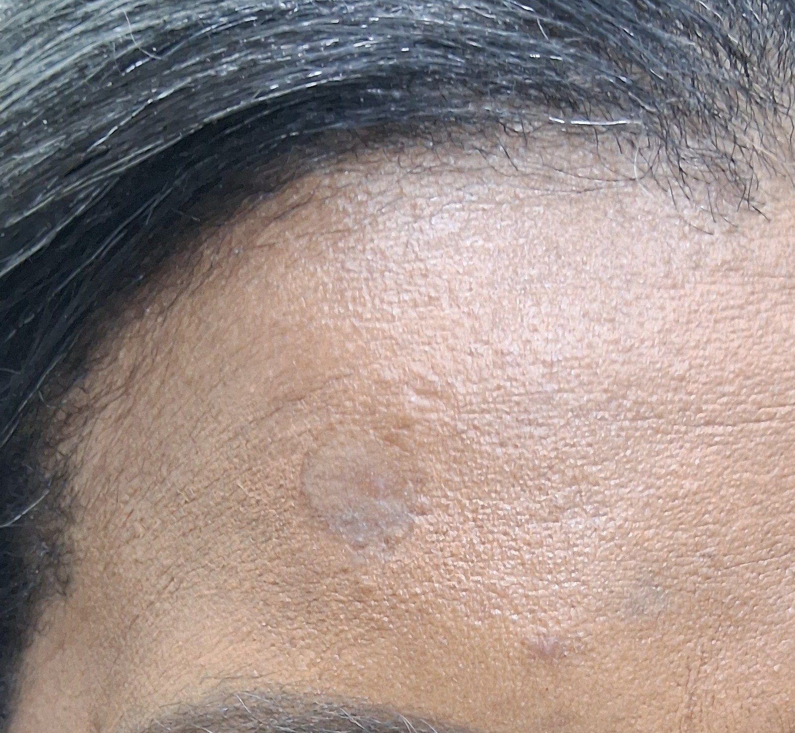 After: Lipoma