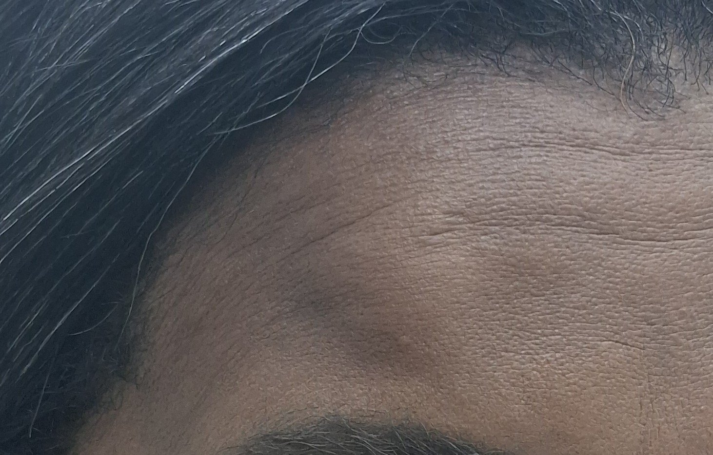 Lipoma
