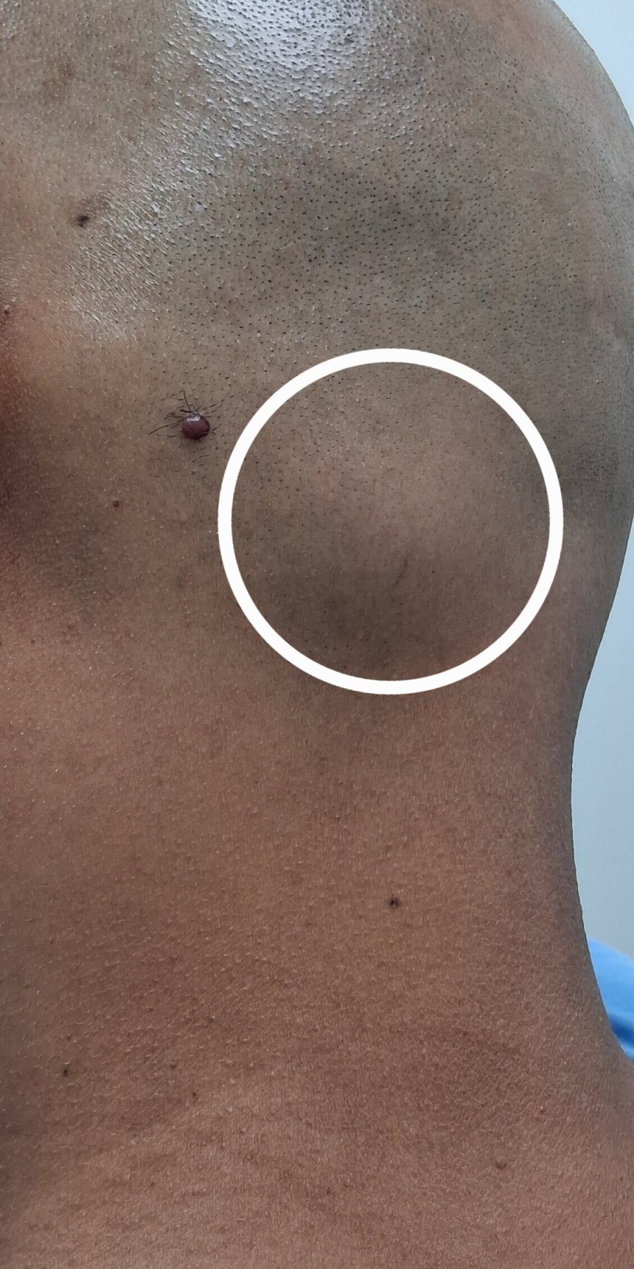 Before: Lipoma