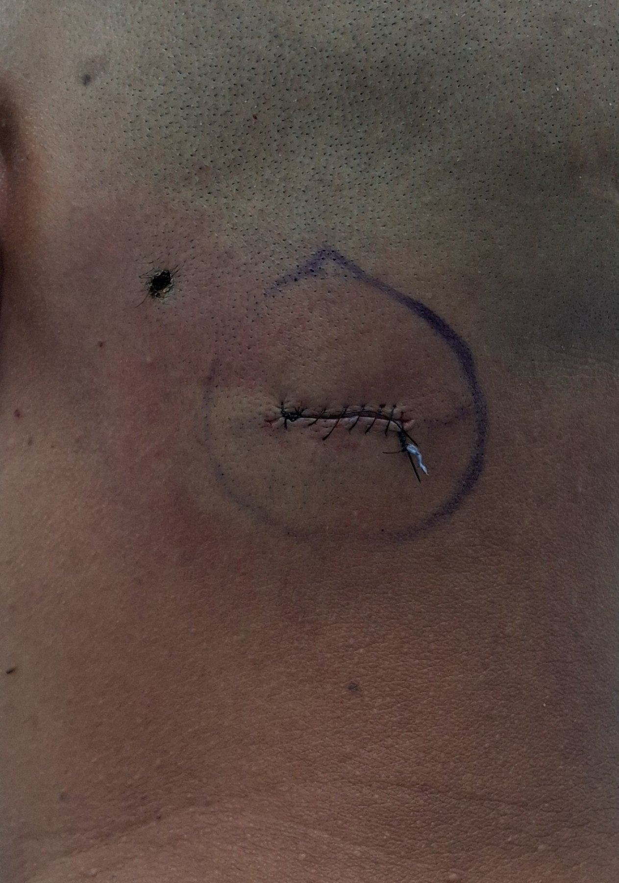 After: Lipoma