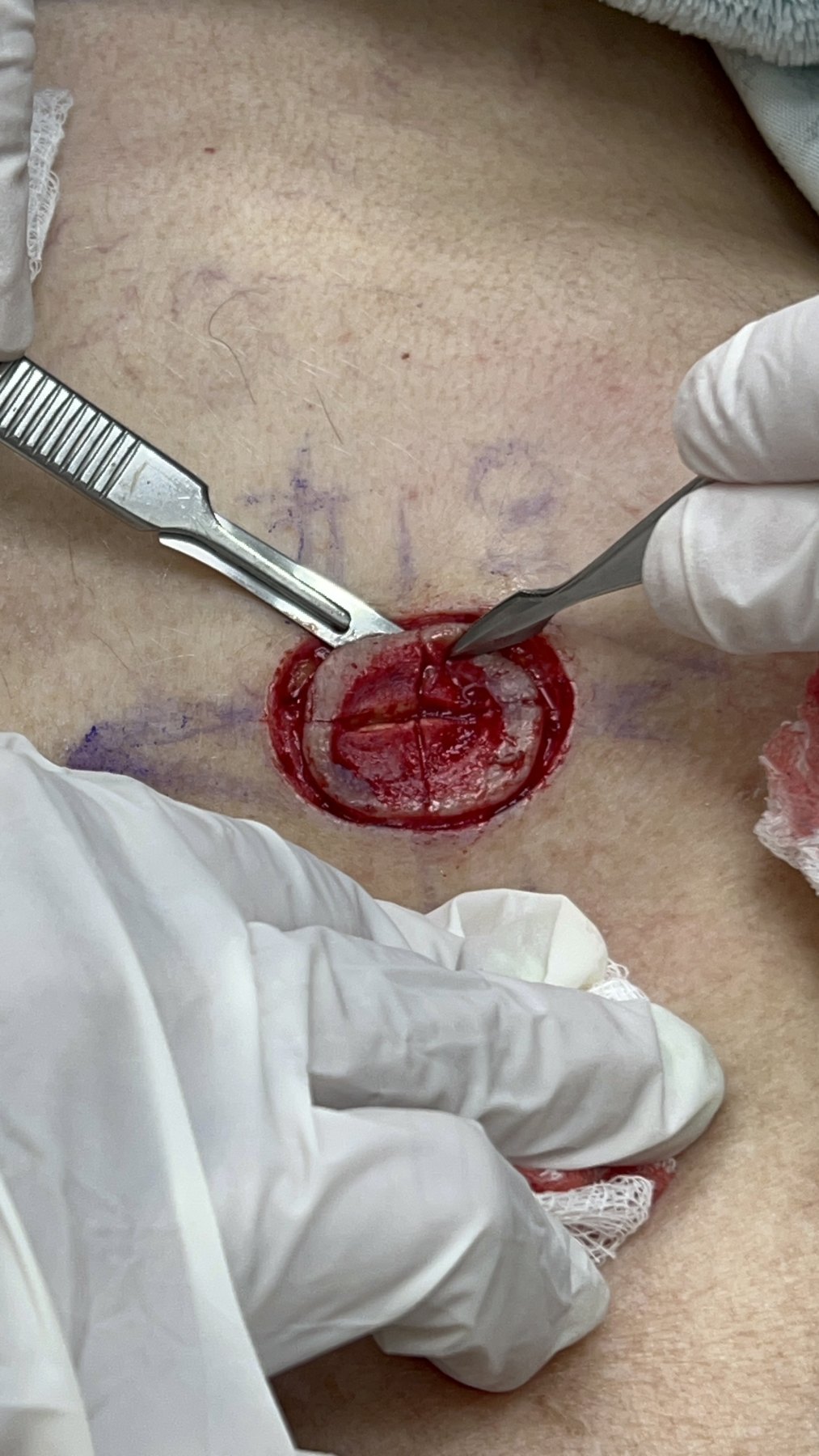 Before: Cirugía de Mohs con control microscópico  y reconstrucción
