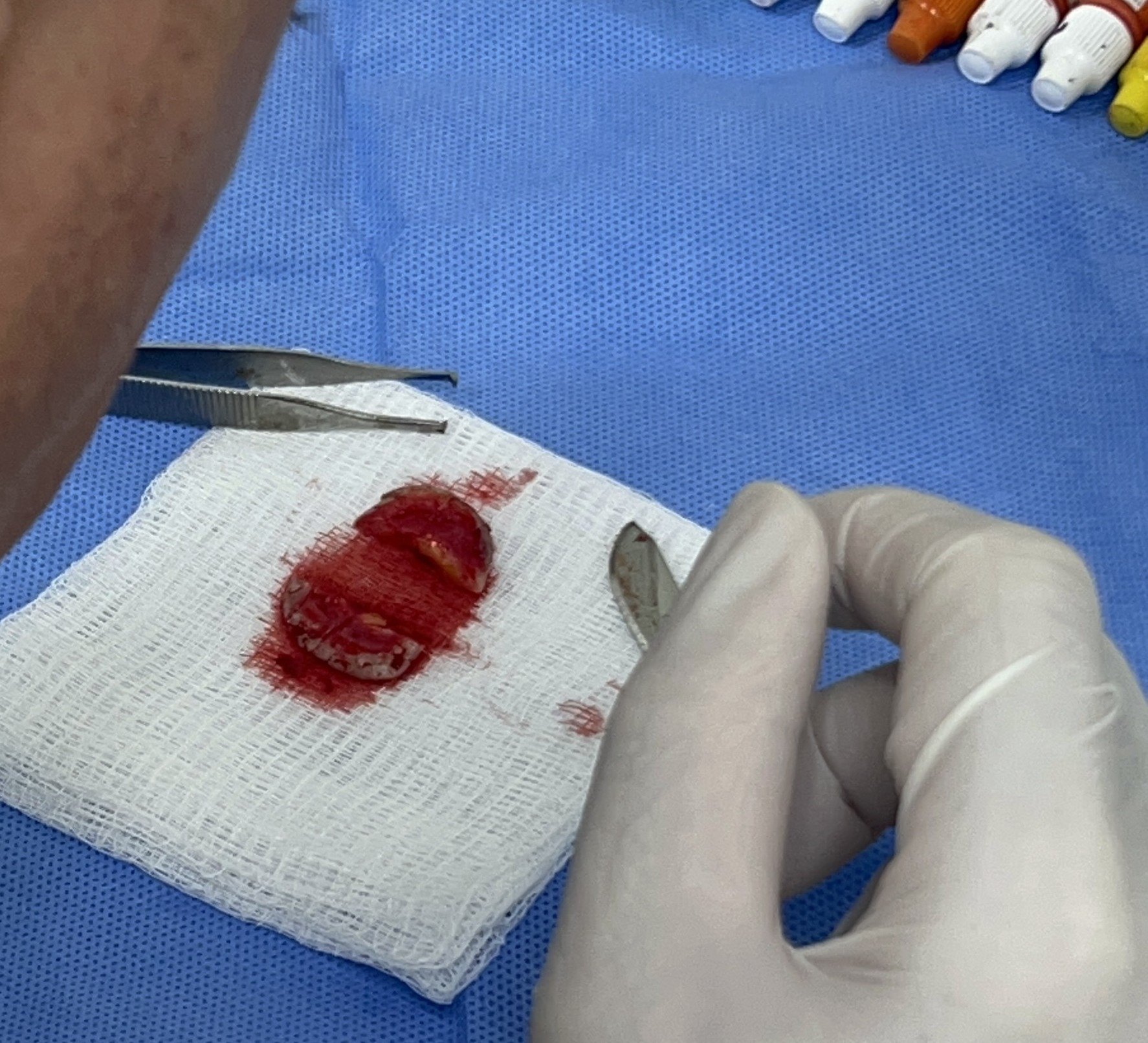 After: Cirugía de Mohs con control microscópico  y reconstrucción