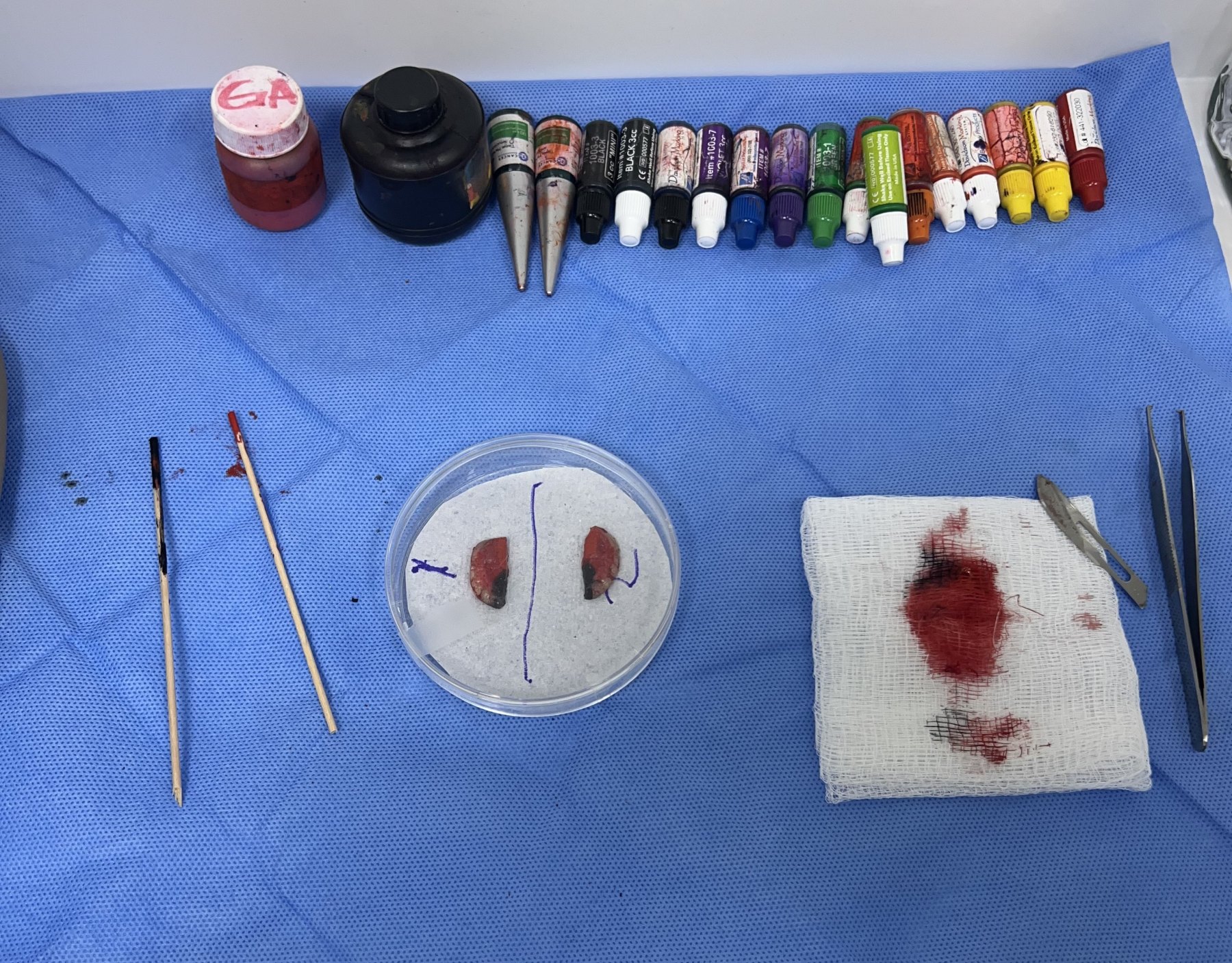 Cirugía de Mohs con control microscópico  y reconstrucción