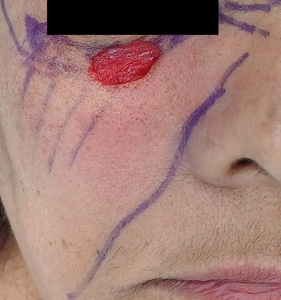 Before: Cirugía de Mohs con control microscópico  y reconstrucción