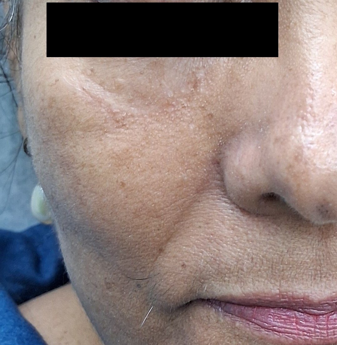 After: Cirugía de Mohs con control microscópico  y reconstrucción