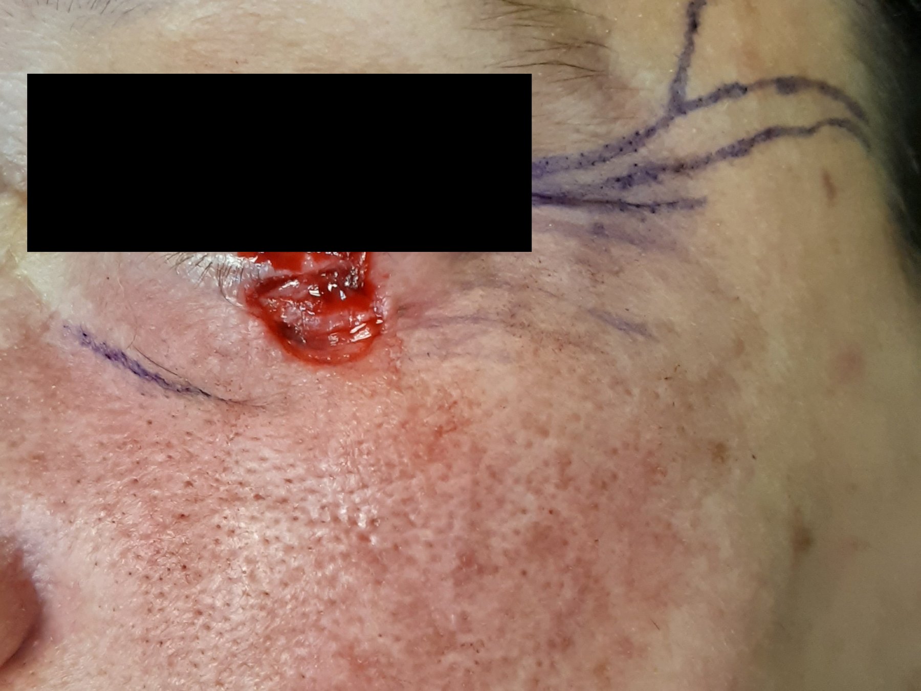 Before: Cirugía de Mohs con control microscópico y reconstrucción