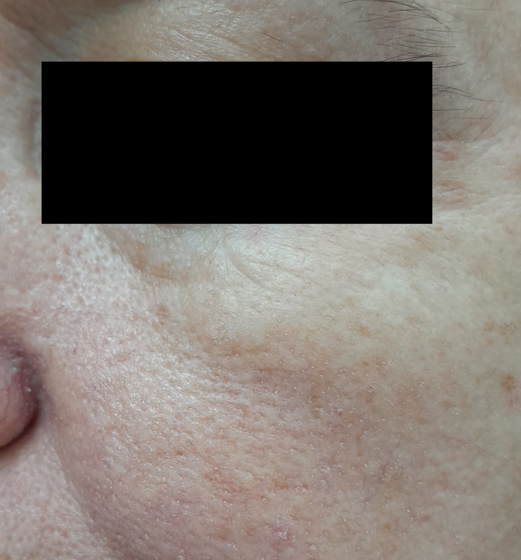 After: Cirugía de Mohs con control microscópico y reconstrucción
